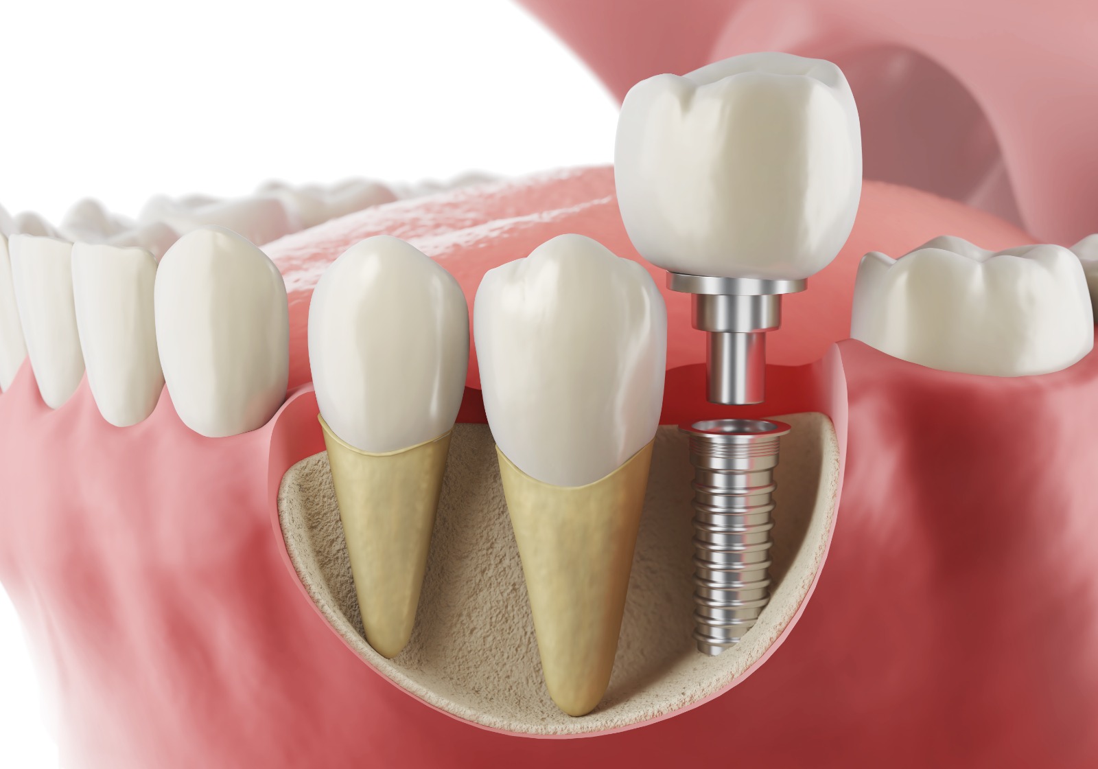 Choose #N0.1 Affordable Dental Implants in Kukatpally