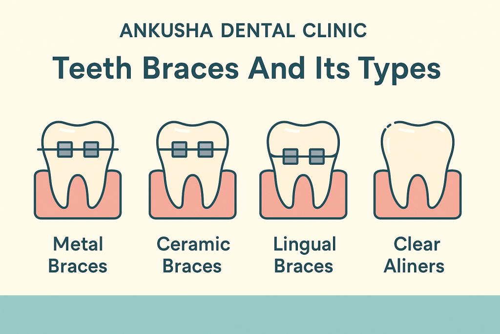 Teeth Braces And It's Types