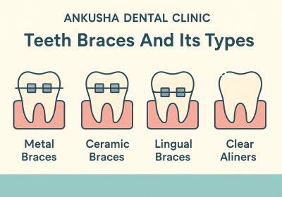 How Teeth Braces Work and the Different Types