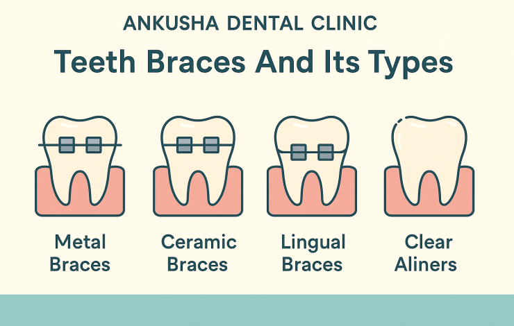 Teeth Braces And It's Types